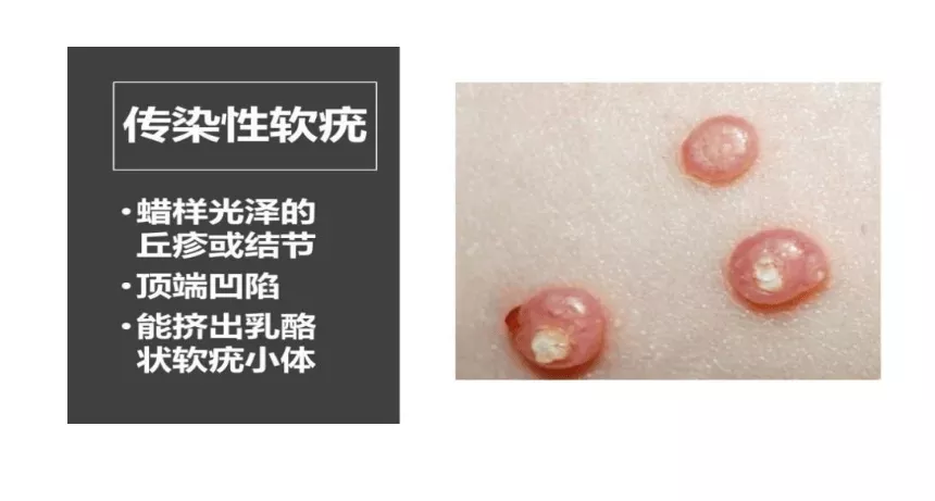 女孩游泳20多天全身长20多个疣!医生提醒:泳池是传播高危区